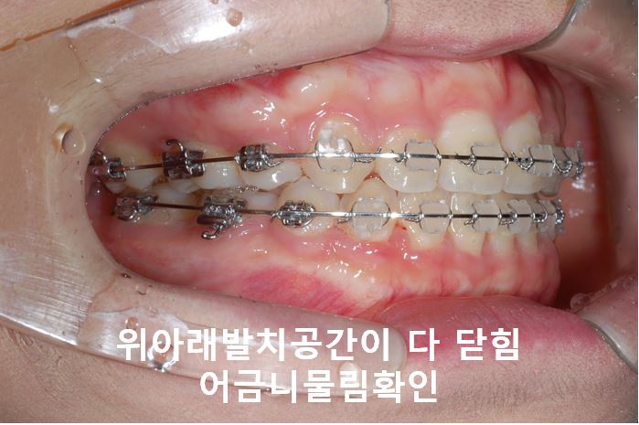 강남역돌출입교정, 옥니방지비법!! 관련 이미지 7