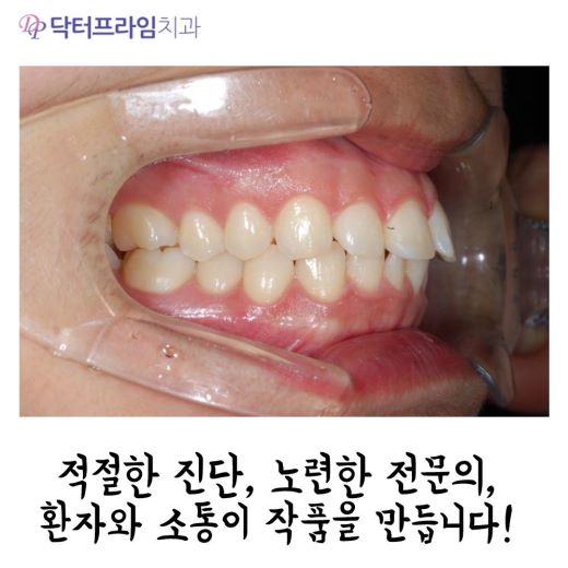 잇몸돌출교정 방법, 사진으로 보는 교정 방법! 관련 이미지 4