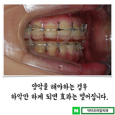 주걱턱교정 치료 보통은 양악수술 보다 하악을 먼저 생각 하지만… 관련 이미지 3