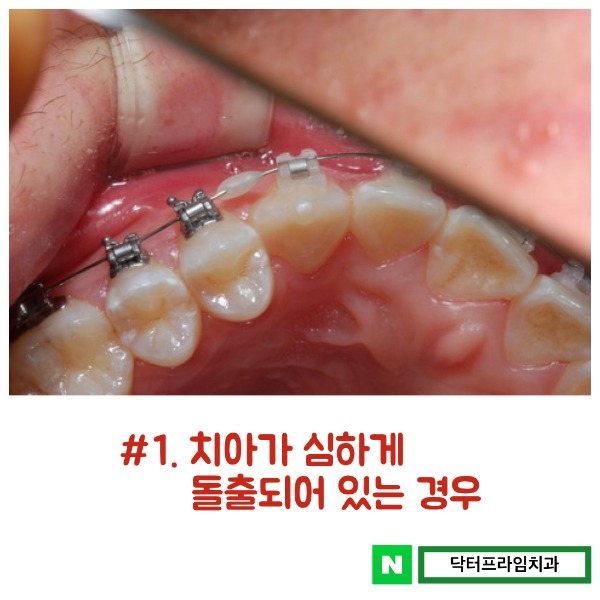 치아교정 발치 어떤 치아를 뺄 것인가? 관련 이미지 2