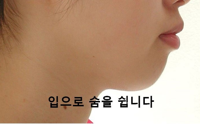 돌출입교정의 효과적인 시기! 관련 이미지 5