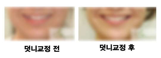 [치아교정후기] 송곳니덧니와 덧니교정전후 관련 이미지 3