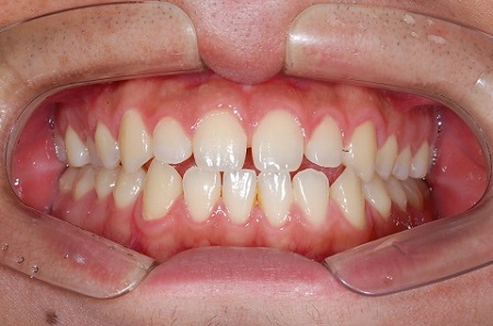 부정교합(덧니,돌출입,주걱턱,무턱,안면비대칭)은 무엇이며 왜 생기는가! 관련 이미지 6