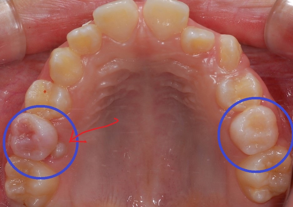 [유치흔들림과 영구치교환] 영구치 보이고 유치가 앞뒤로 1mm 흔들리면 집에서 발치도 가능! 관련 이미지 2