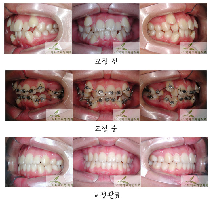 [치아교정후기] 중고등학생 덧니교정후기. 중고등학생은 진행속도가 빠릅니다!! 관련 이미지 1