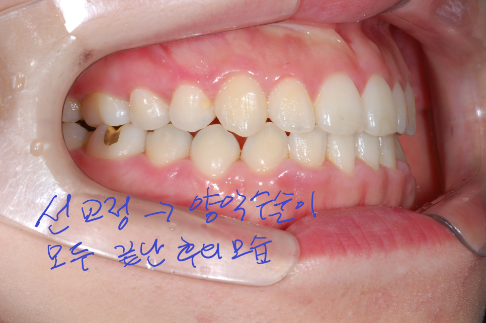 [치아교정] 양악수술방법. 선수술(=후교정)과 선교정(=후수술) 어느것이 더 좋을까? 관련 이미지 5