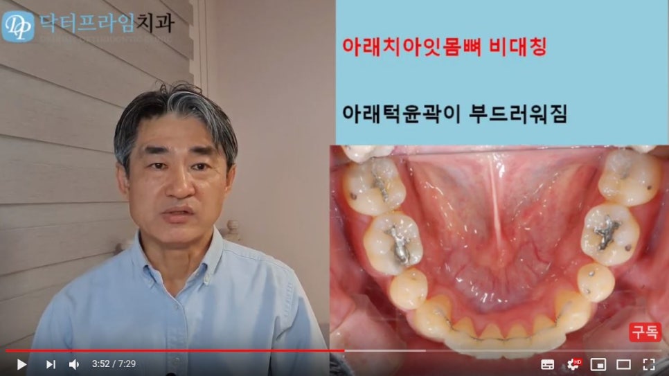 얼굴이 이뻐지는 치아교정! (덧니, 비대칭, 돌출입) 관련 이미지 8