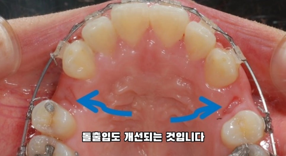 돌출입 교정 하실 분, 이것만은 꼭 알고 시작해야 합니다! 관련 이미지 4
