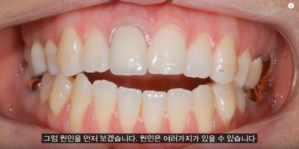 [치아교정] 개방교합의 증상, 원인,교정방법(앞니개방교합) 관련 이미지 2