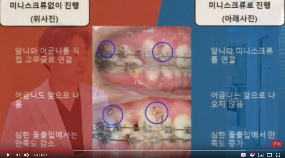 돌출입교정용나사(미니스크류) 많이 아파요? 관련 이미지 1