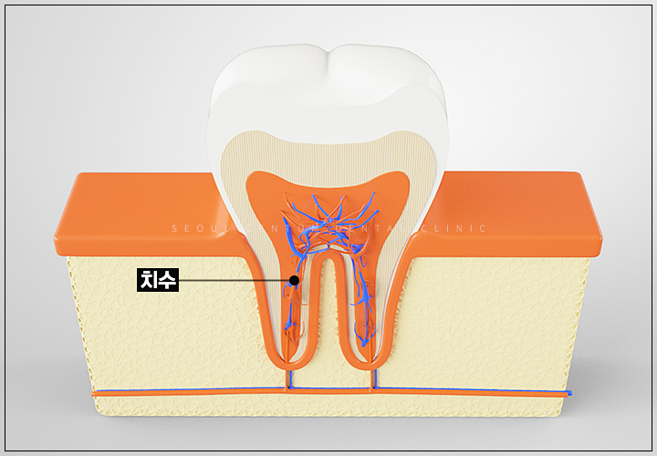 임플란트 뼈이식이 필요한 경우 구체적으로 확인하고 싶다면 관련 이미지 6