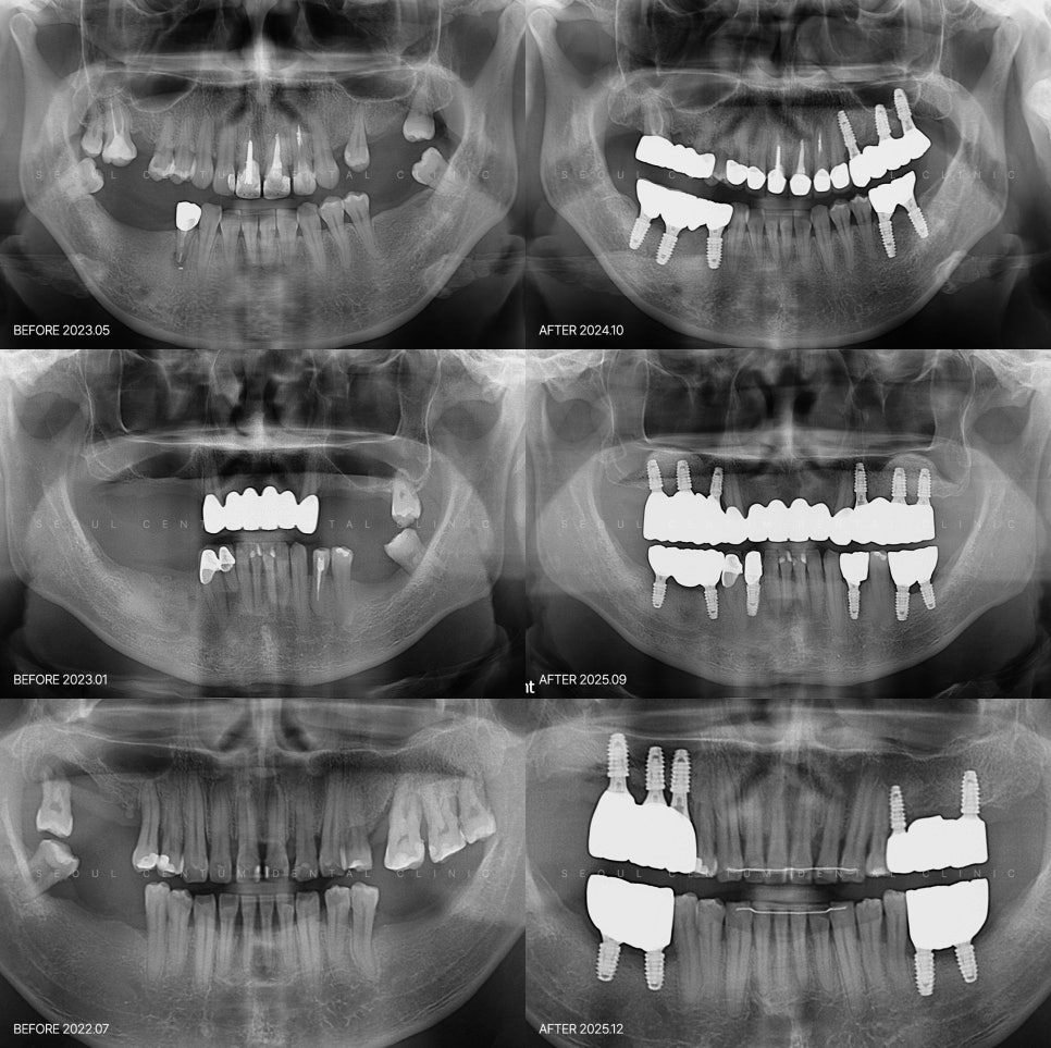 전체임플란트 가격 발품 시 악당 전악 뜻 모르면 헷갈릴 수 있습니다 관련 이미지 7