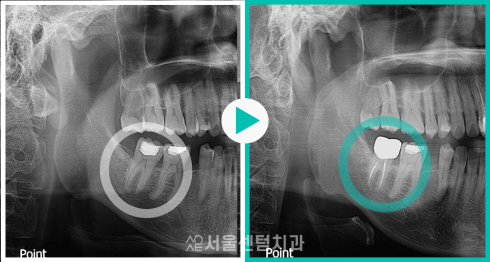 Explaining the Root Canal Treatment Process with Actual Dental Photos image 4