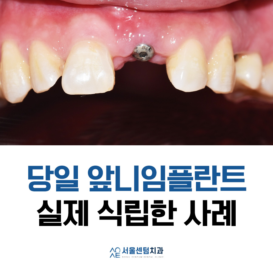 당일임플란트 상담부터 풀과정 공개 관련 이미지 1