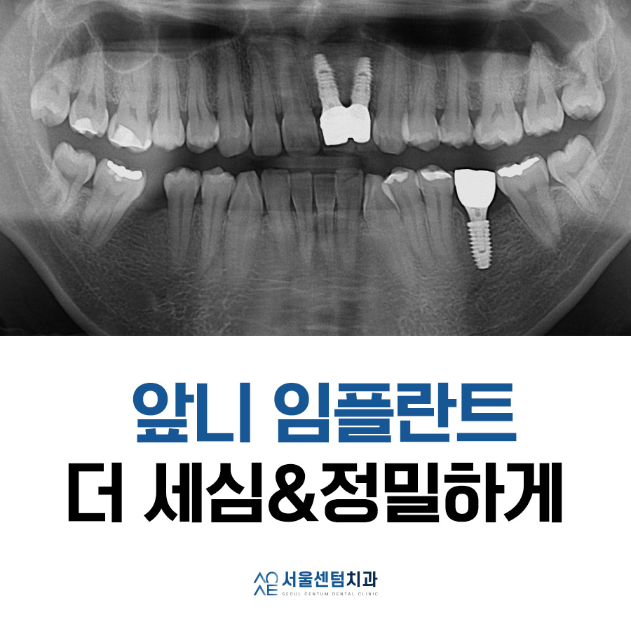 앞니 임플란트 후기 실제사례 보여드려요 관련 이미지 6