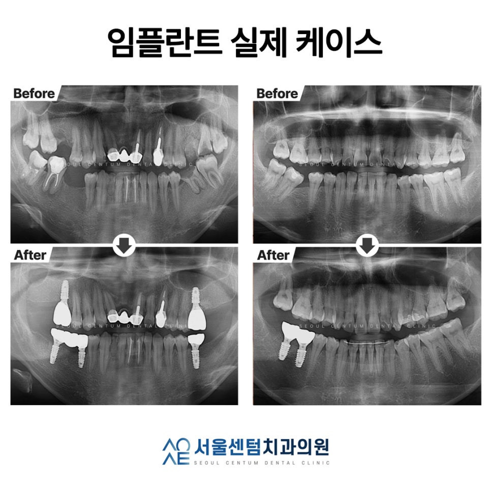 서울임플란트치과 후회없이 고르는 기준 관련 이미지 5