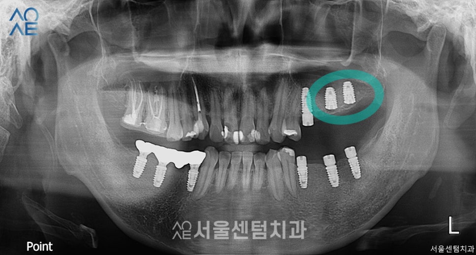 30대임플란트 치아상태 좋지 않아도 안심 관련 이미지 6