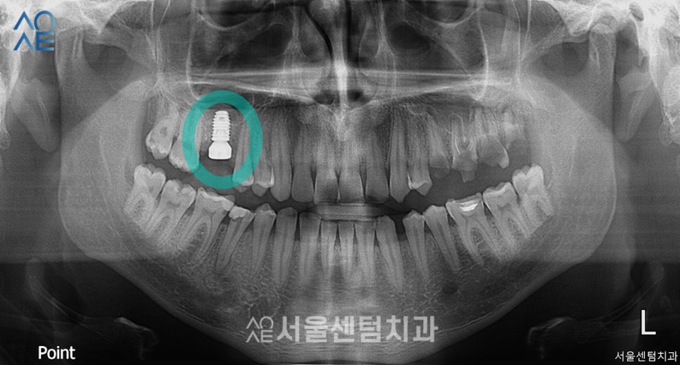 20대임플란트후기 진행과정부터 상세히 관련 이미지 2