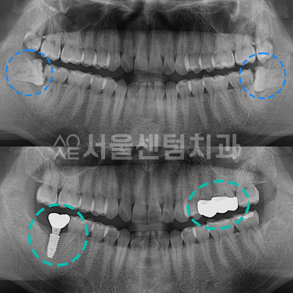A Successful Molar Implant Case in a Patient in Their 20s image 9