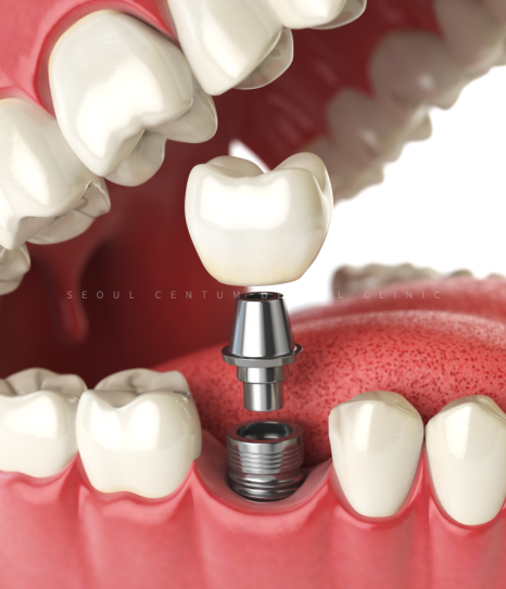 임플란트 브릿지와 크라운 수복으로 치아 기능을 회복시킨 증례 관련 이미지 22