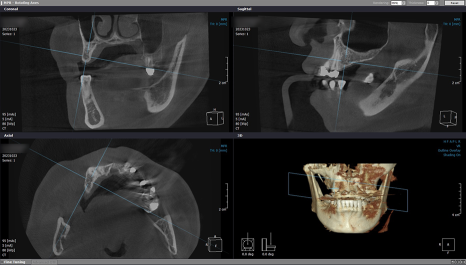 임플란트 브릿지와 크라운 수복으로 치아 기능을 회복시킨 증례 관련 이미지 12