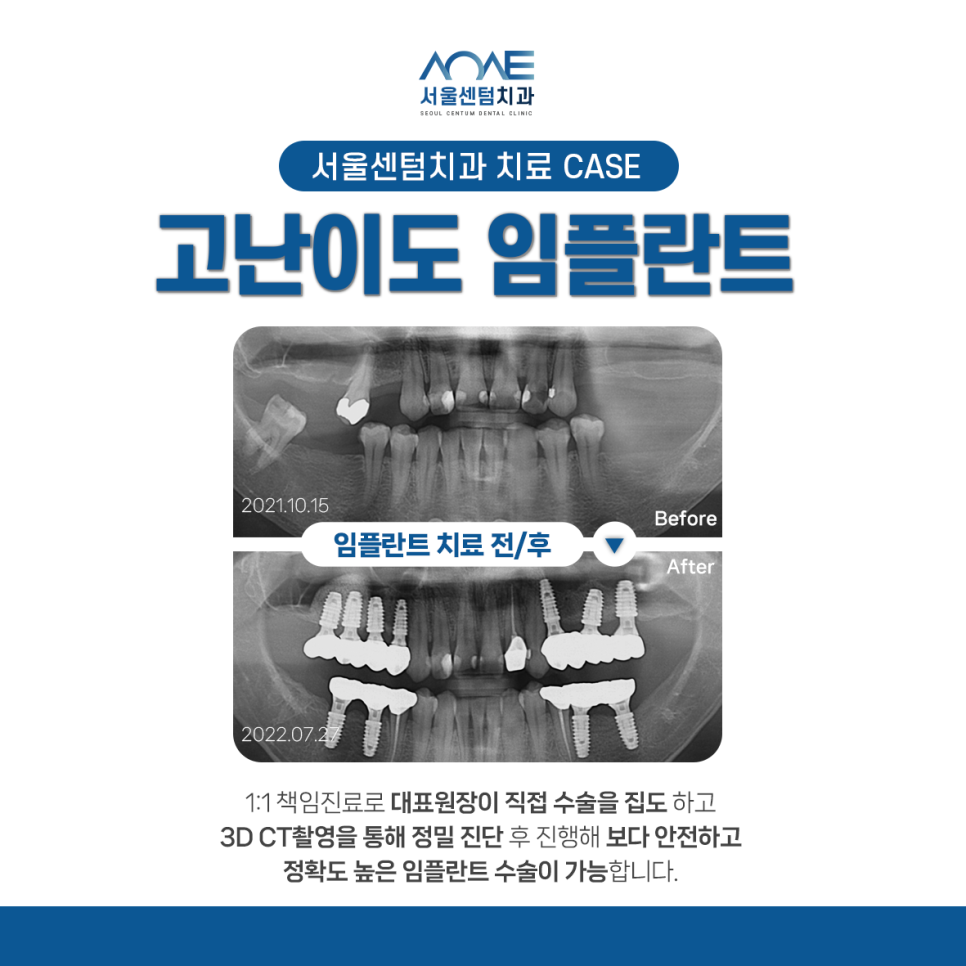 발치 후 임플란트 꼭 해야하는 이유 (잇몸뼈 소실, 쓰러짐, 정출) 관련 이미지 10