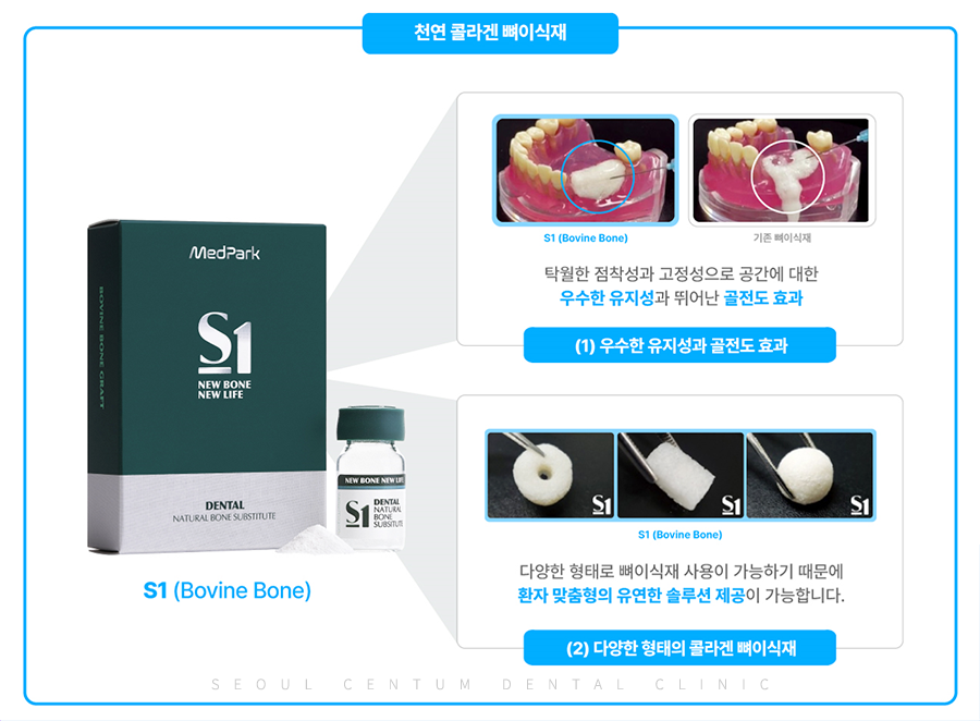 뼈이식 임플란트와 라미네이트 수복 증례 소개 관련 이미지 15