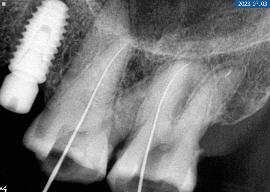 임플란트 브릿지와 크라운 수복으로 치아 기능을 회복시킨 증례 관련 이미지 10