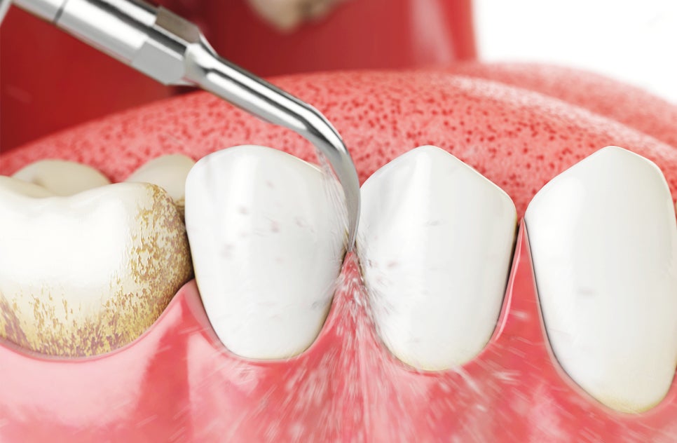 치아 스케일링 후 이시림 통증 완화법은? 관련 이미지 2