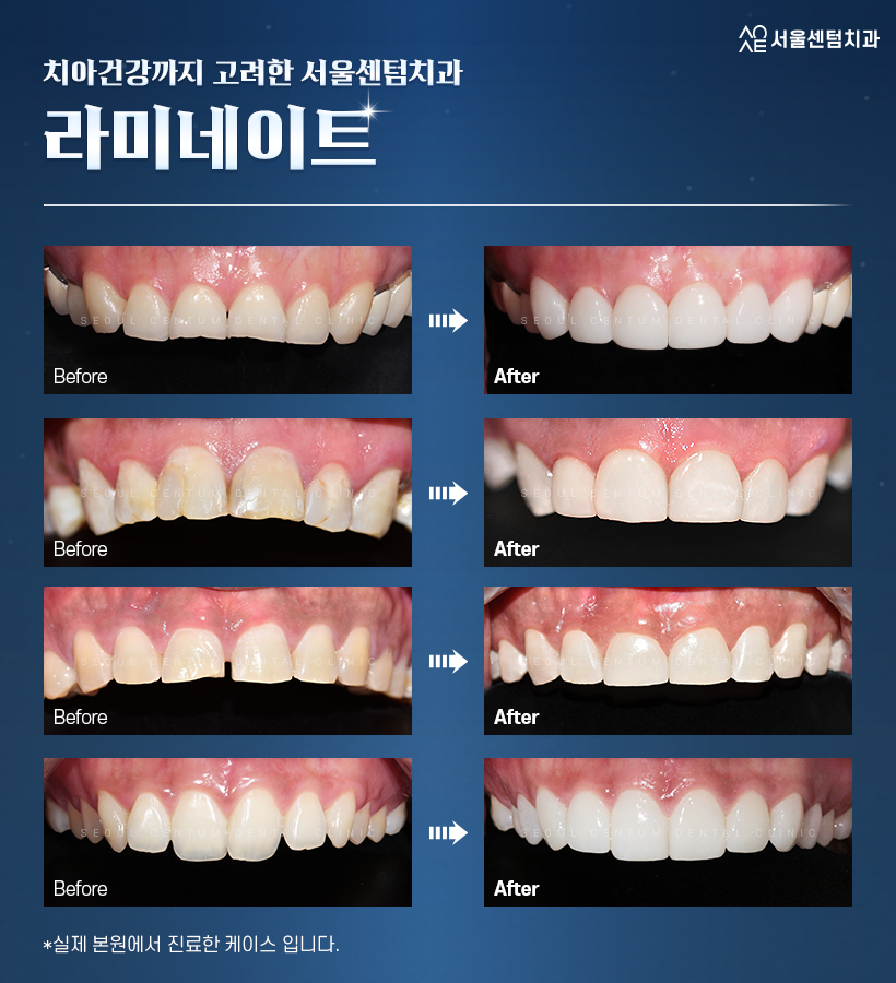 강남 라미네이트 치과 치아삭제 최소화 관련 이미지 8