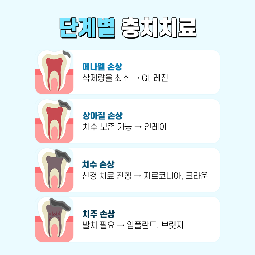 충치치료 나는 어떤 단계일까 관련 이미지 3