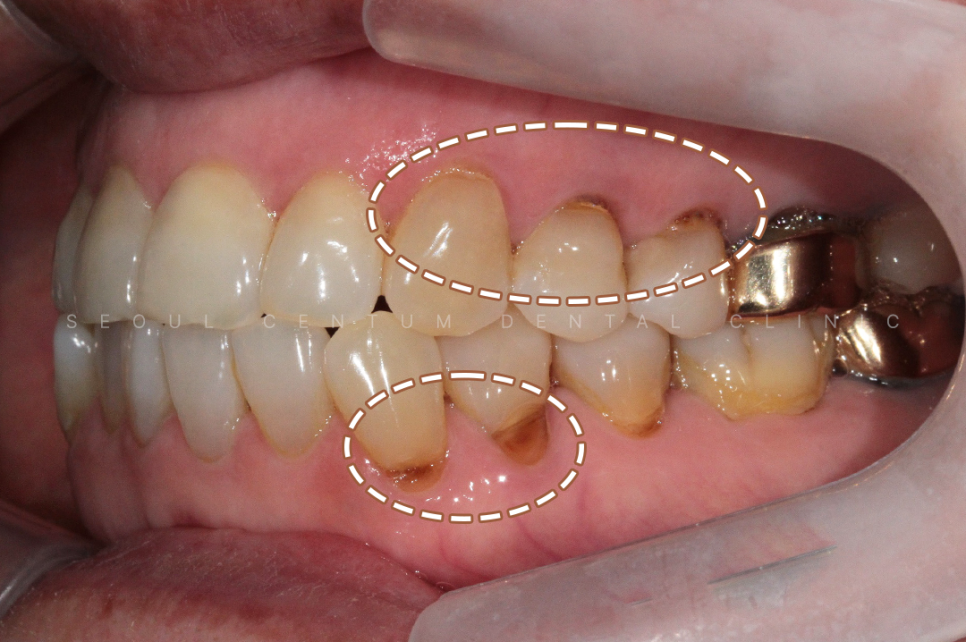 치경부마모증 가격 gi 레진 갈색치아 원인 통증 관련 이미지 14