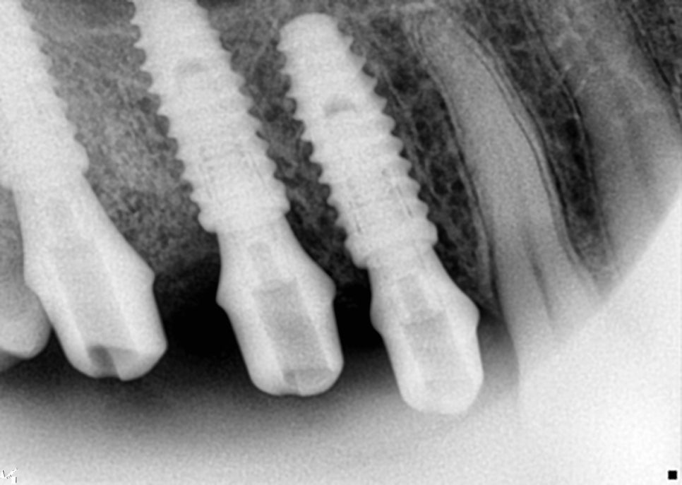 40대 임플란트 치료 케이스 상악동거상술 골이식까지 관련 이미지 12