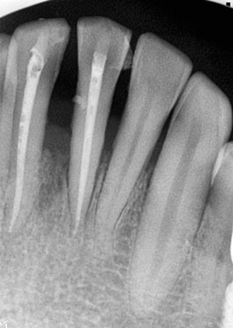 임플란트 순서 어금니부터 앞니부터 어디부터 해야할까요 관련 이미지 8