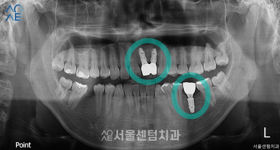 앞니 임플란트 후기 실제사례 보여드려요 관련 이미지 4