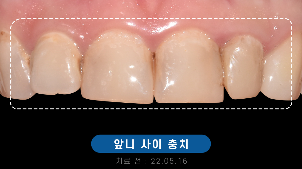 치과 앞니 사이 레진, 당일 진료 가능 관련 이미지 11