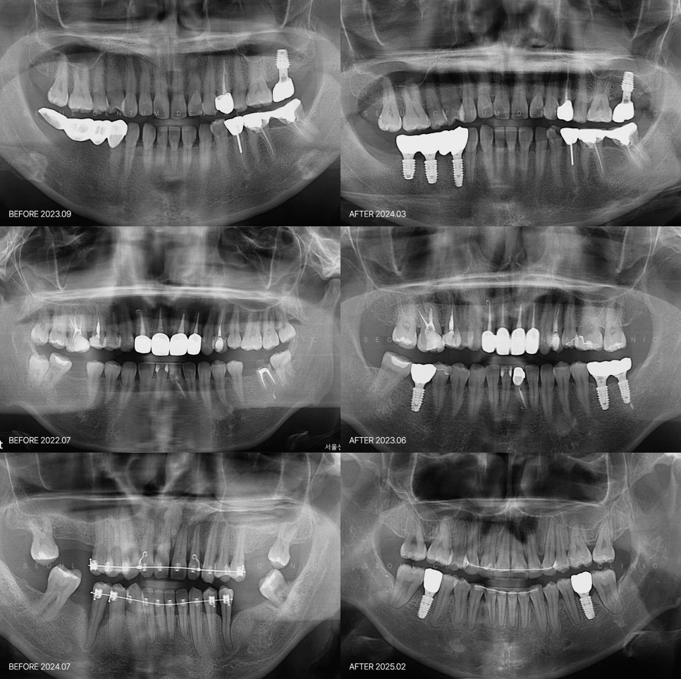 어금니 깨졌을 때 통증별 치료법 관련 이미지 5