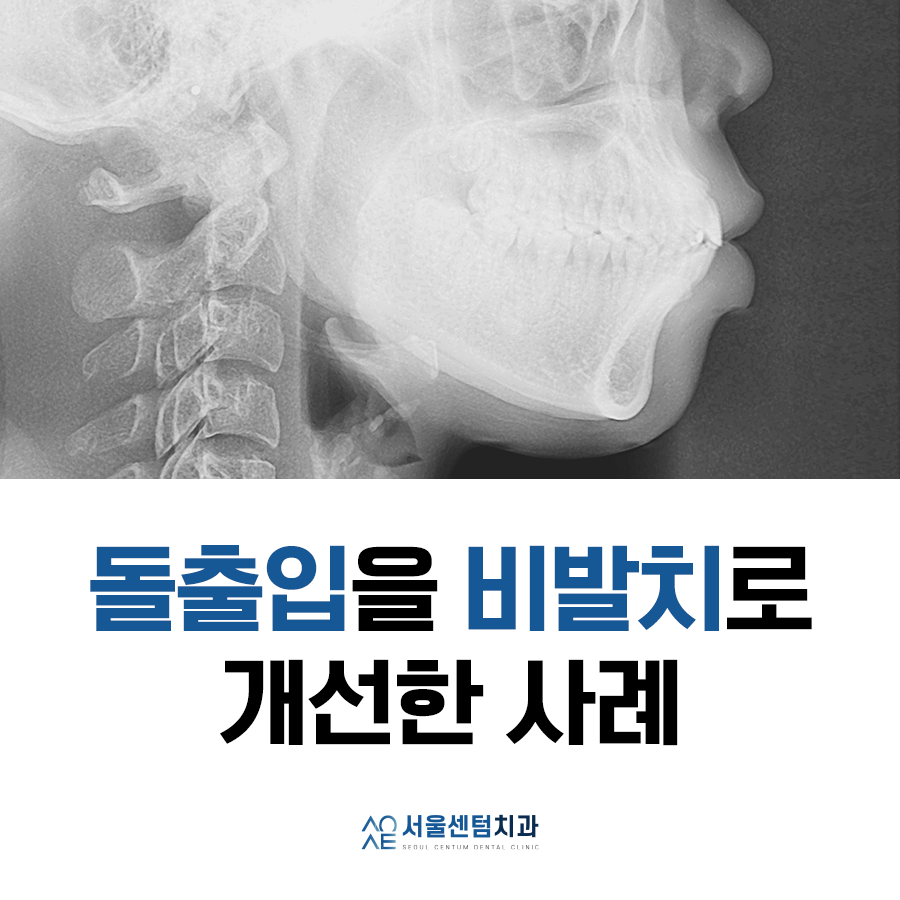 비발치로 돌출입 해소한 증례 관련 이미지 1