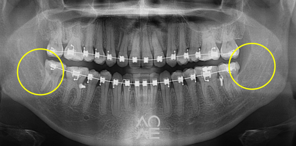 사랑니 발치 통증 붓기 줄이는 법 관련 이미지 6
