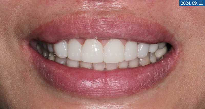 라미네이트전후 치아의 가지런한 정도와 밝기 차이 확인하기 관련 이미지 12