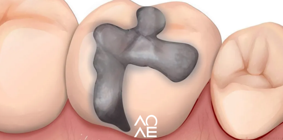 강남양심치과에서 오래된 아말감 교체하세요! 관련 이미지 4