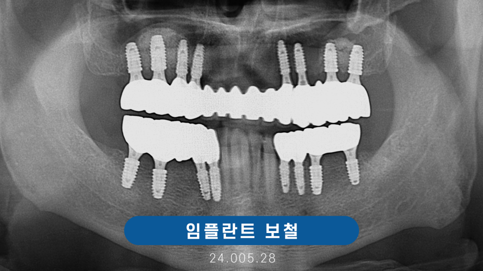 전체임플란트 노인틀니 보험 실비 비용 관련 이미지 8