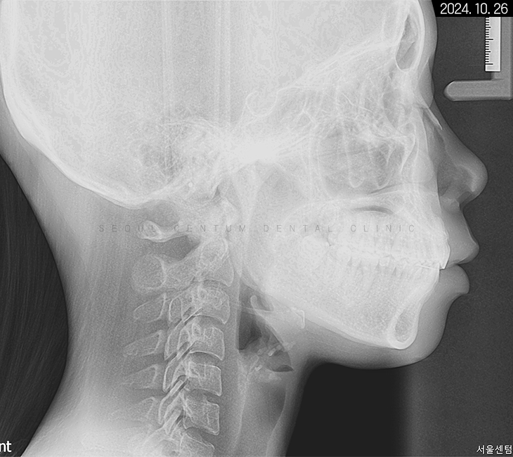 비발치로 돌출입 해소한 증례 관련 이미지 10