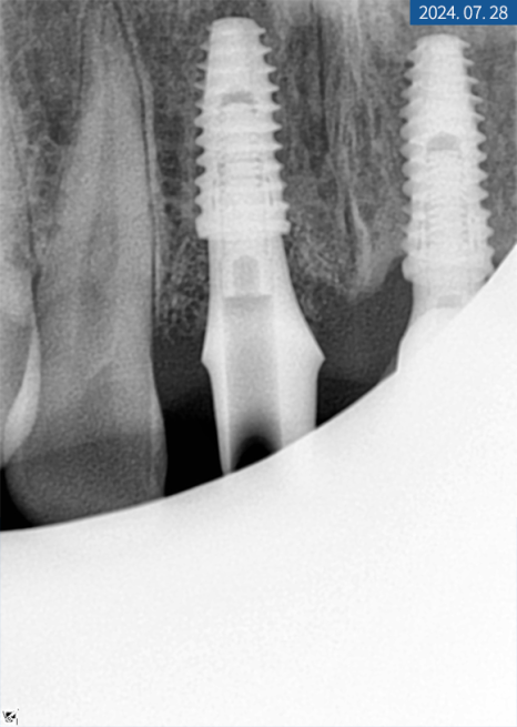 앞니 임플란트 식립으로 저작 기능을 끌어올린 증례 관련 이미지 12