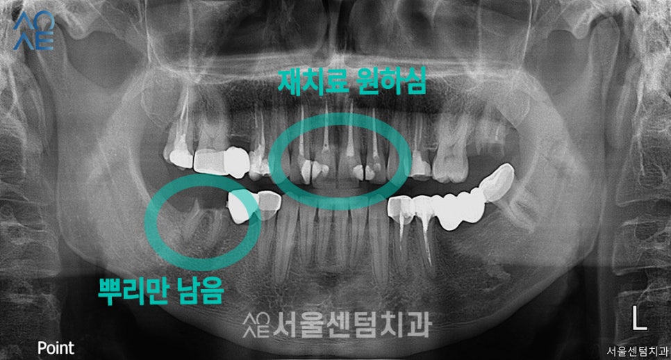 20대임플란트 처음이라 두렵다면 관련 이미지 1