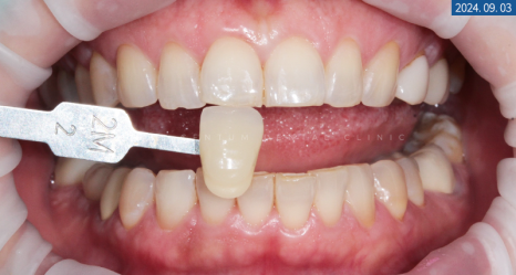 라미네이트전후 치아의 가지런한 정도와 밝기 차이 확인하기 관련 이미지 6