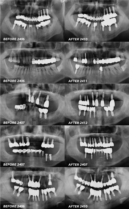 앞니임플란트 후기 찾아보고 골라야 하는 이유 왜 중요할까 관련 이미지 6
