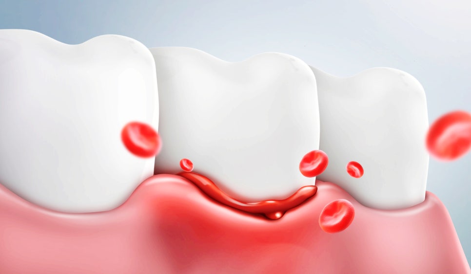 잠원역임플란트 1차수술 흡연 음주 안되는 3가지 이유 관련 이미지 6