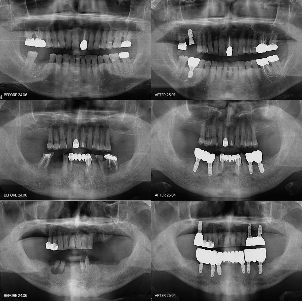 임플란트 재수술 실패가 아니라 처음 선택의 문제일 수 있습니다 관련 이미지 7