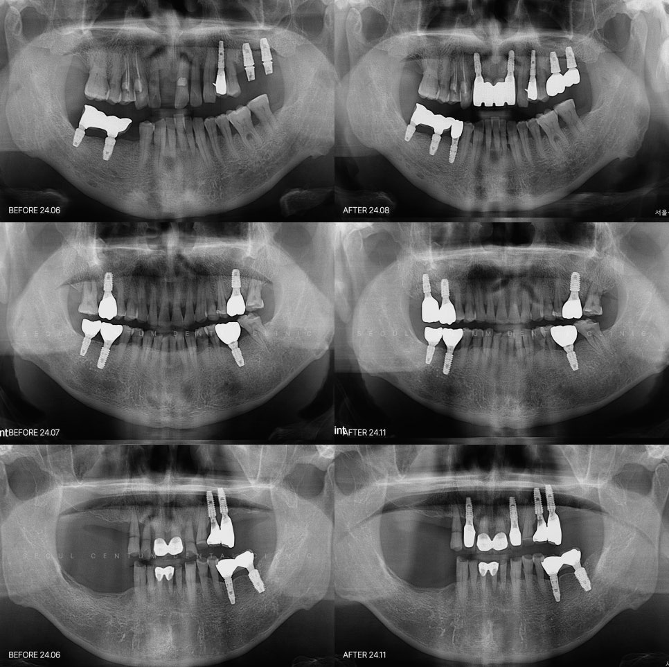 전치부 앞니 심미보철치료 중요한 이유 기능보다 먼저 보이는 치아이기 때문 관련 이미지 6